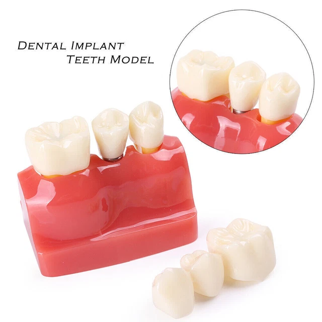 Dental Equipment Implant Analysis Crown Bridge Demonstration Teeth Model Tools