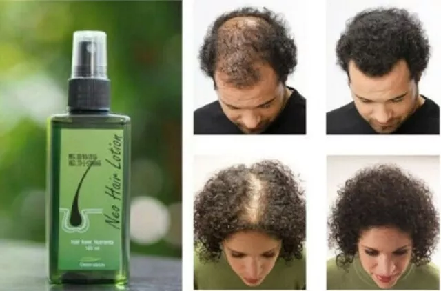 Neo Hair Lotion Natural Crecimiento Tratamiento Caída Del Cabello /Entresacar