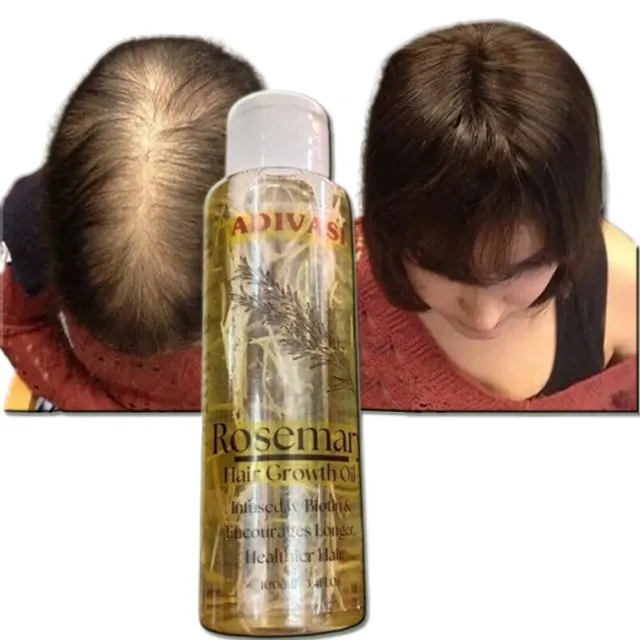 Aceite de romero crecimiento del cabello cuero cabelludo hombres mujeres jengibre anti pérdida de cabello crecimiento 100 ml
