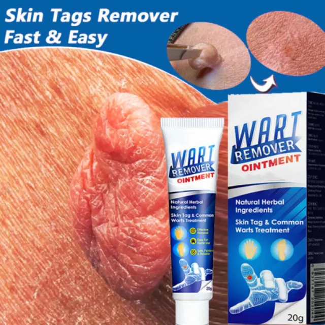 2x Warzenentferner Wart Tag Removal Creme Behandlung Papillome Entfernung Haut