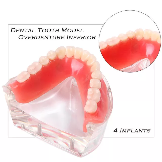 1Pcs Dental Zähne Modell mit 4 Implantaten Demo Deckprothese minderwertig