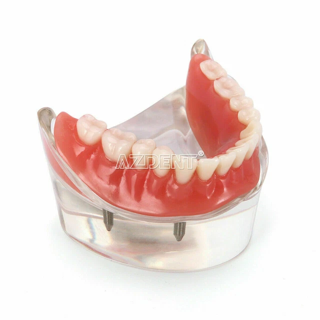 Dental Demonstration 4 Implants Teeth Model Typodont Inferior Overdenture Lower