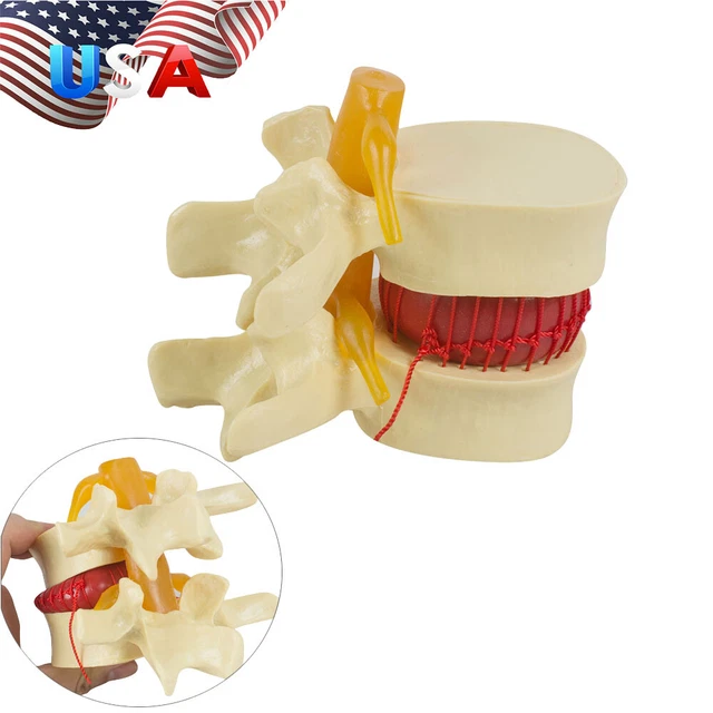 11.5 MEDICAL LUMBAR Spine Model Disc Herniation Demonstration Teach