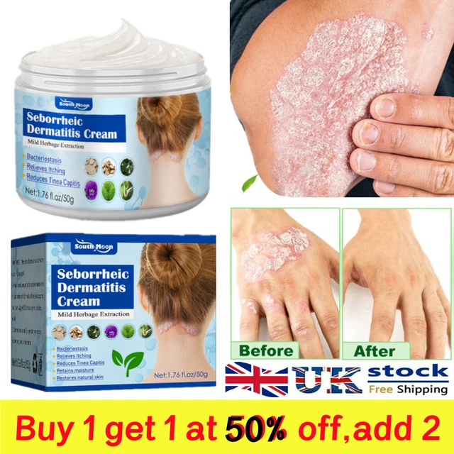 SEBORRHEIC DERMATITIS CREAM Scalp Treatment For Psoriasis Eczema