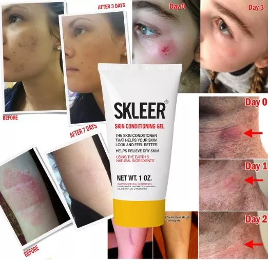 Acne, Pimples, Psoriasis,  Natural Gel with Tea Tree Oil - SKLEER Gel