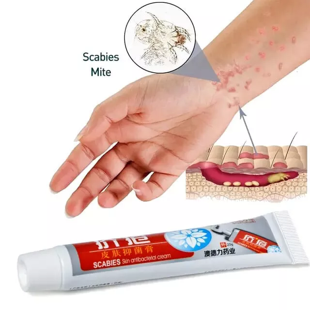 Natural  Pubic Lice Herbs Cream Treatment Scabies Mite Psoriasis Anti-itch