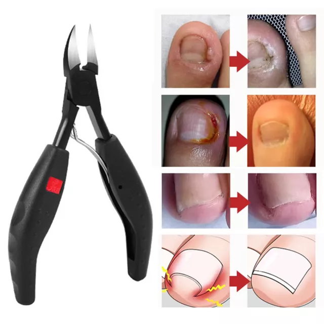 Paronychia Pédicure Peau Morte Enlever La Correction Des Ongles D'orteil #