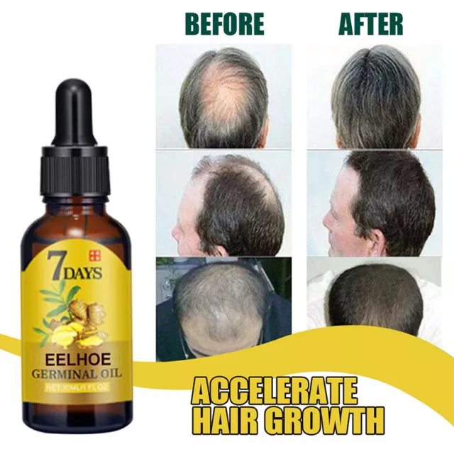 Nachwachsen 7 Tag Ingwer Germinal Haarwachstum Serum Friseur Öl Verlust Q
