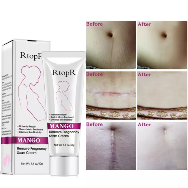 NATURAL BETTER BREASTS Kit for Stretch Marks Sagging Breast Firming SPF 50  Set 3 $142.21 - PicClick