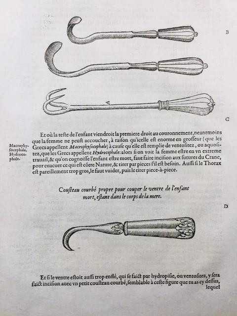 Gravure Sur Bois Originale Ambroise Paré 1585 - Jumeaux Siamois, Médecine Ancienne