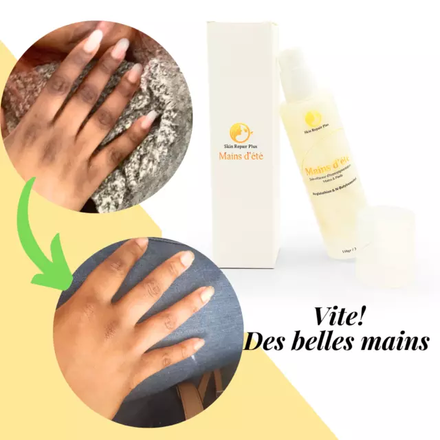 Crème SOIN  Effaceur d'hyperpigmentation pour phalanges, pieds 2