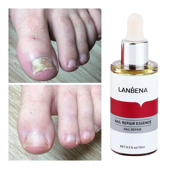 NAIL FUNGUS TREATMENT Killer Anti Fungal Infection Cure Treat Toe