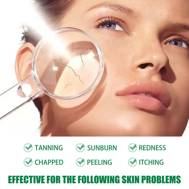 Aerosol calmante reparador de aloe vera para alivio del acné quemaduras solares hidratante C4Z3