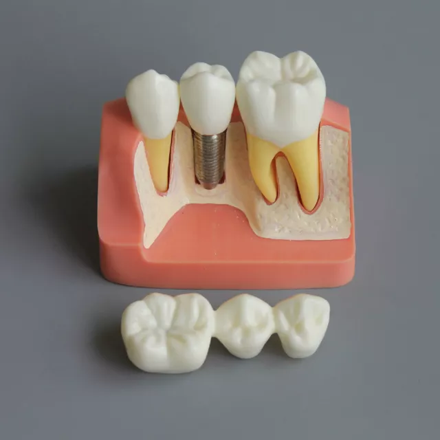 New Dental Study Implant Analysis Crown Bridge Demonstration Teach Teeth Model