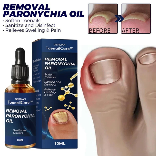 Aceite de alivio de ranura de uñas reparación de uñas encarnada uña gris para uñas cuidado de carne de uñas Oi#