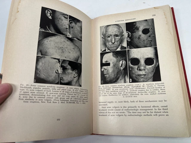 1952 Dermatology Sulzberger Wolf SKIN GRAPHIC antique medical book oddity