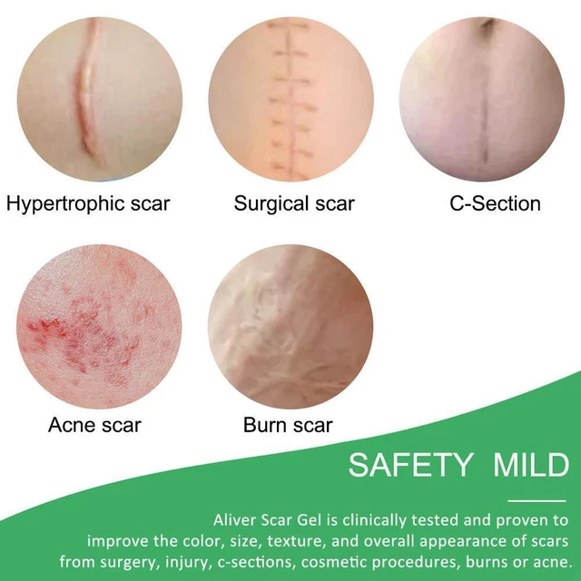 Strisce gel di silicone Aliver patch riparazione Scar Away Away W8J8 M1J9 W4F8 Z1J5