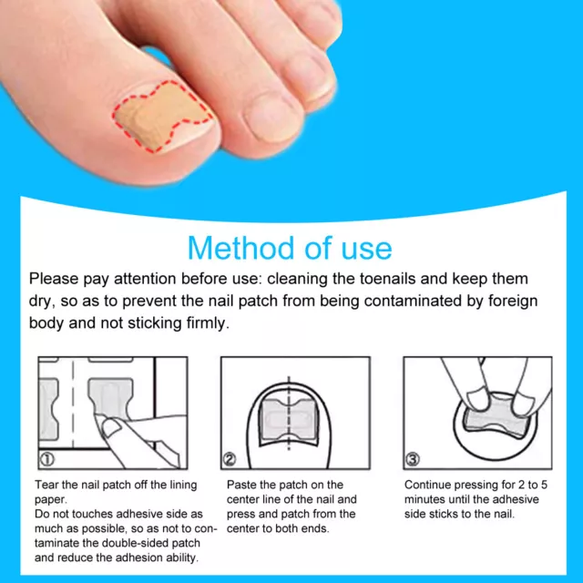 (120x)Ingrown Toenail Correction Patch Foot Care Pedicure Sticker Toenail IDS