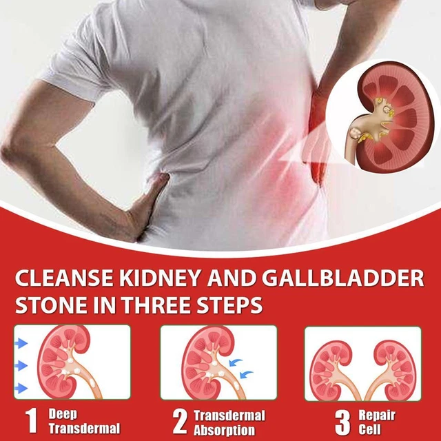 Parche de cuidado renal cálculos renales prevención de cálculos biliares 6 piezas B2B5