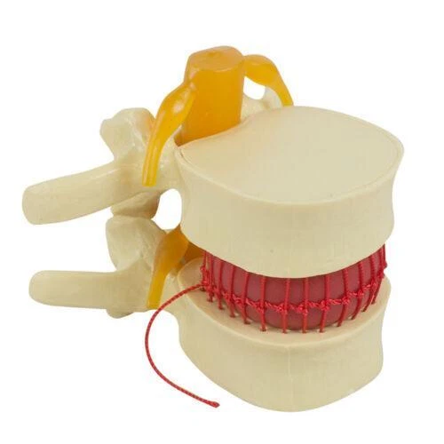 11.5 PVC LUMBAR Disc Herniation Model for Medical Education Detailed