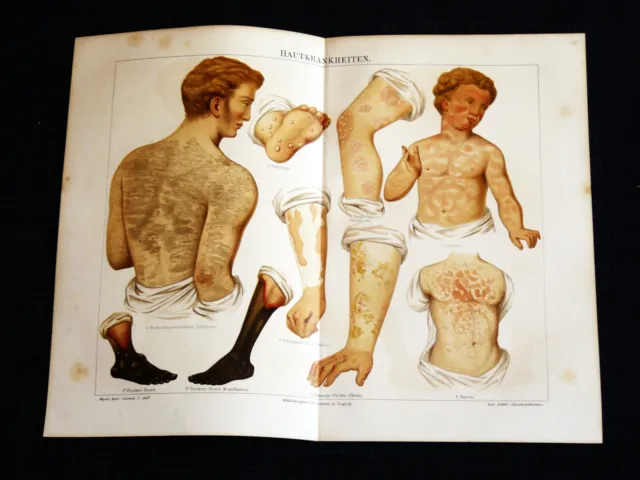 HAUTKRANKHEITEN Masern Brand Flechte Herpes Scharlach Lithographie 1895