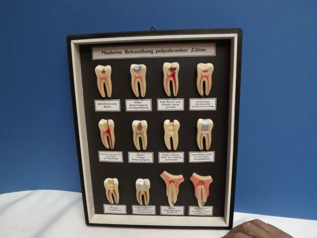 Teeth Model [ Museum ] Wax Model { Tooth Decay } Fine [ Berlin ] C1920 { Dentist