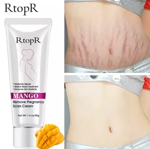 40g RtoprR Mango Pregnancy Stretch Scars Marks Remove Cream Treatment UK-SELLER