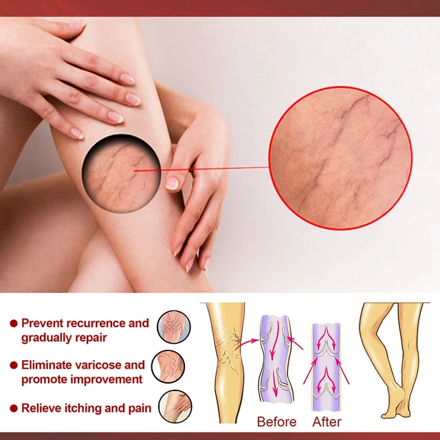 Body Vasculitis Phlebitis Spider Pain Relief Plaster Unisex Health Care Patches 11