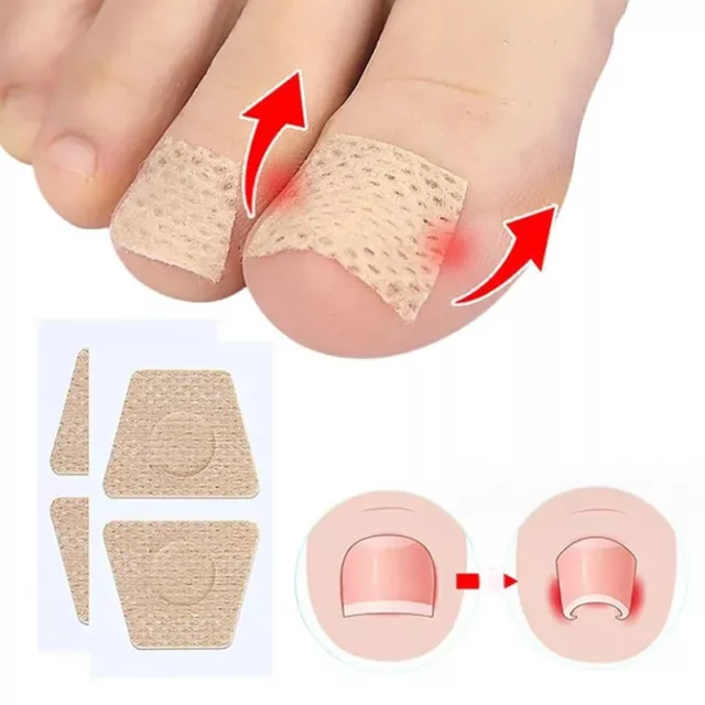 2/10Pcs Ingrown Toenail Toe Correction Stickers Nail Art Foot Patches Feet Care