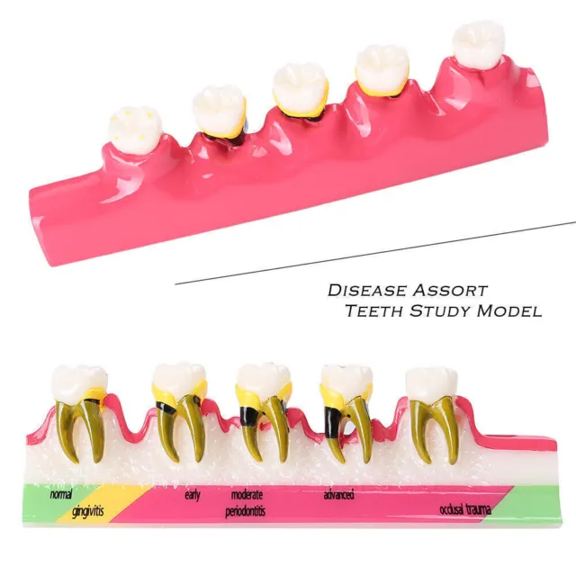 NEW Dental Lab Periodontal Disease Assort Tooth Typodont Teeth Model Study Model