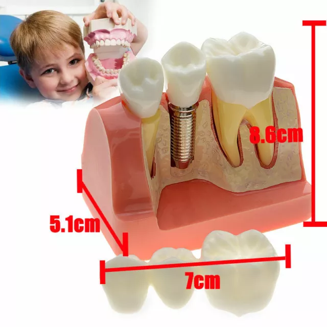 New Dental Implant Analysis Crown Bridge Demonstration Teeth Model Teach Study