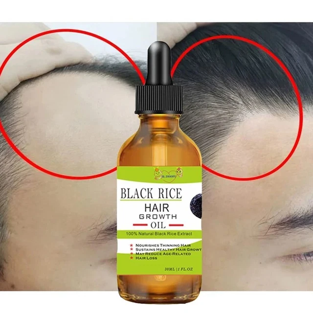 Extracto de loción para el crecimiento del cabello pérdida de cabello aceite calvicie reparación