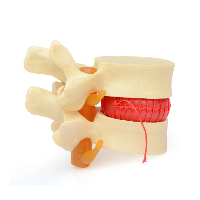 HUMAN ANATOMY LUMBAR Disc Herniation Model Medical Learn Aid Anatomy
