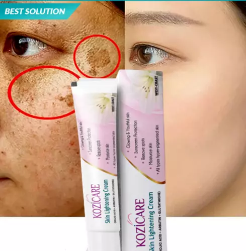 Strong Removal Melasma Whitening Cream Sunburn Spots Pigment Freckle Speckle