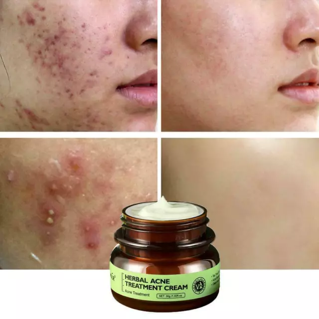 Anti acne cream Herbal scar removal oily skin Acne care skin Spotsneu