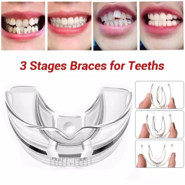 Orthodontic Braces Appliance Dental Braces Bruxism MouthGuard Teeth Straighte-uh