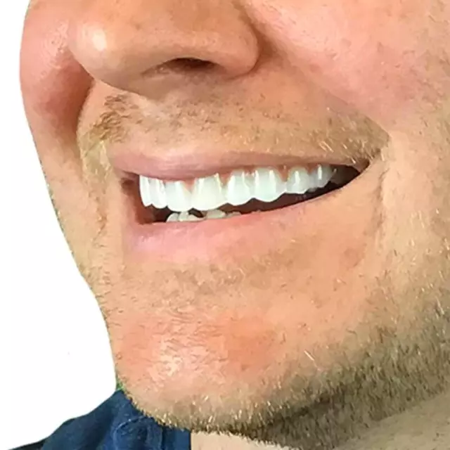 Lächelnde Zahnspangen, falsche obere Zähne, Zahnveneers, Kosmetik