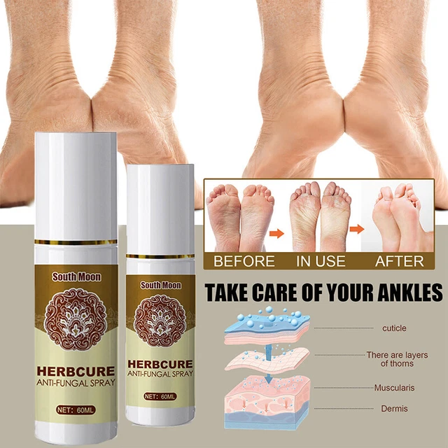 NATURAL HERBAL FUNGUS Combat Feet Spray Anti Fungal Infections Athlete