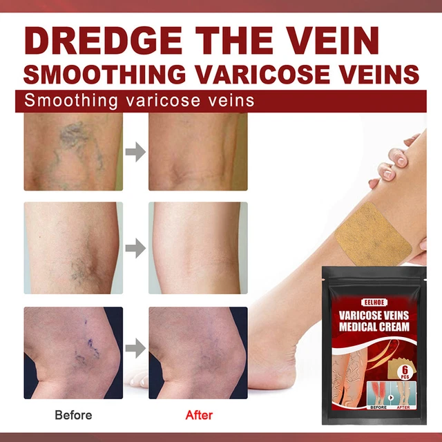 Body Vasculitis Phlebitis Spider Pain Relief Plaster Unisex Health Care Patches 10