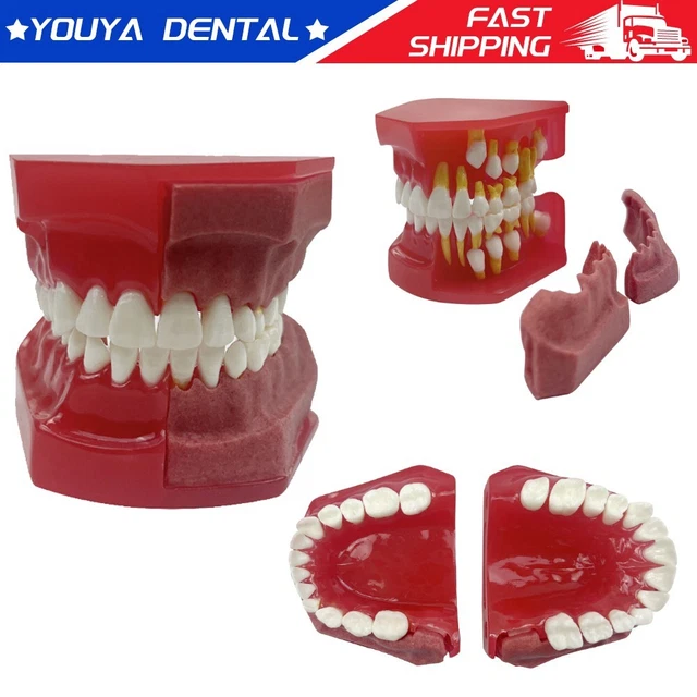 Child Dental Model Deciduous Permanent Teeth Alternate Tooth Demonstration Model
