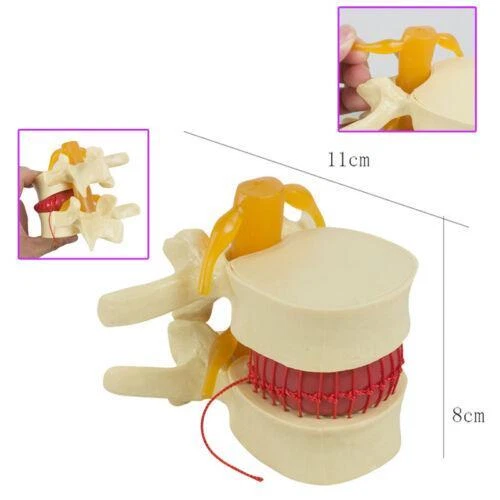 PVC LUMBAR DISC Herniation Spine Model Detailed 11.5 Demo for