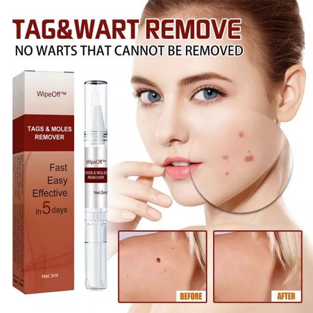 Tag & Wart Treatment Pen Wipeoff  Tags & Moles Remover Quick Safe Skin Care 3ml`