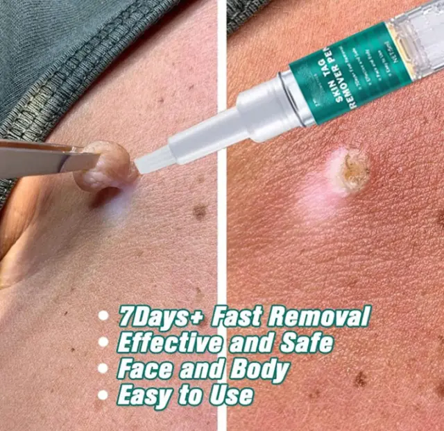 2PCS 3ml Liquid Wart Removal Treatment Pens 🌟 Painless Spot Mole Skin Tag 🔥