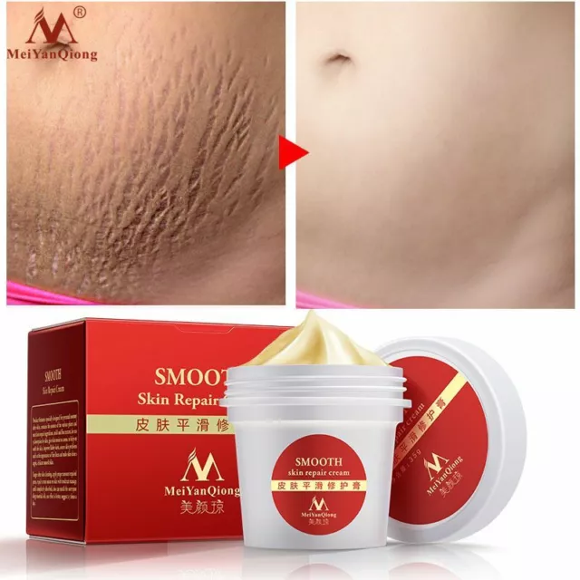 Cream Skin Stretch Scar Removal Marks Repair Mark Acne Remover Care Maternity