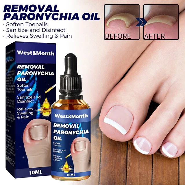 Allemand Toenailcare Huile Pour Enlève Paronychia, Incarné Ongle de Pied Hui,