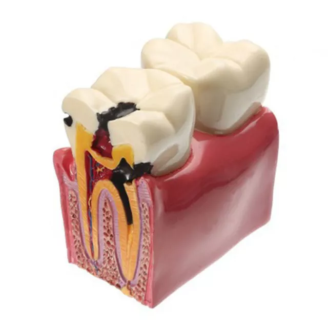 6X Caries Tooth Model Dental Comprehensive Pathological Disease Study Teaching