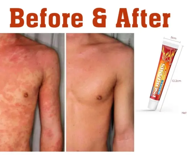 Eczema Dermatitis Psoriasis Skin Gel Cream Ointment Gel Treatment Anti-itching