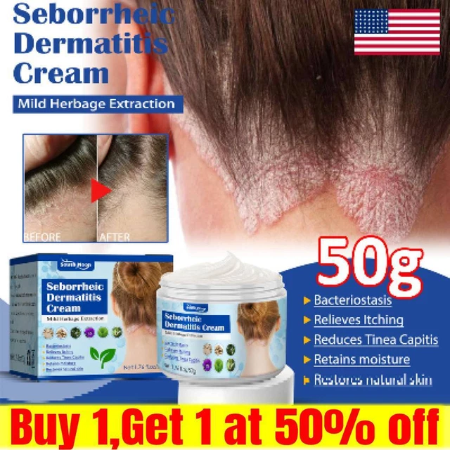 SEBORRHEIC DERMATITIS CREAM Scalp Health Care Psoriasis Cream Eczema