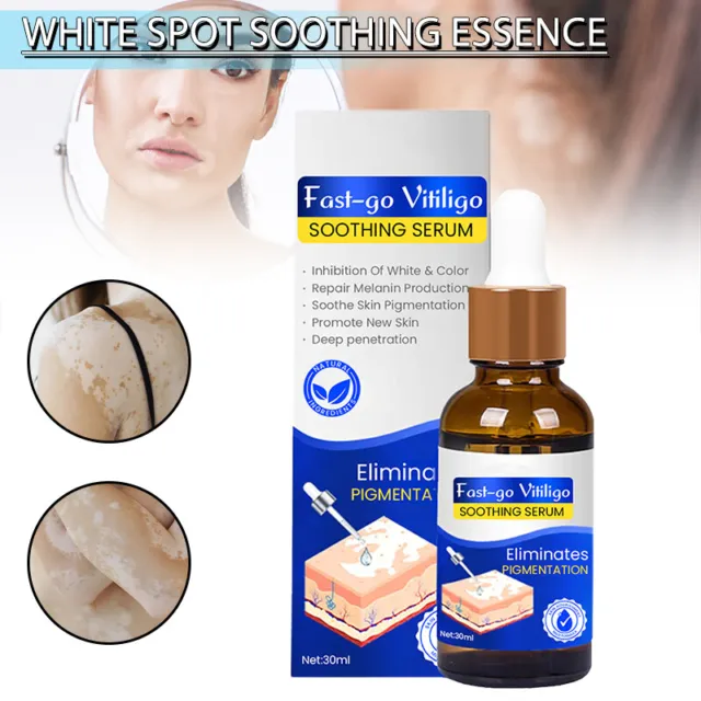 Vitiligo Soothing Serum 30ml White Spot Antibacterial Liquid Leukoplakia H