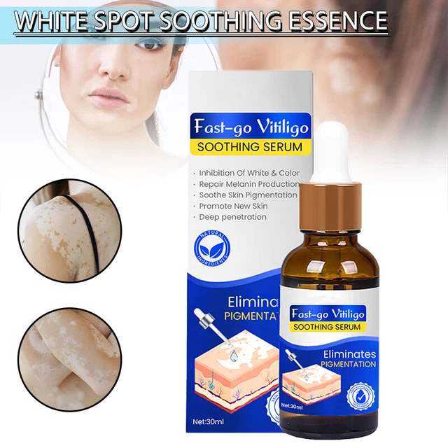 Vitiligo Soothing Serum 30ml White Spot Antibacterial Liquid Leukoplakia H